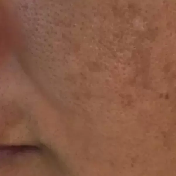 Pigmentation Treatment – Before
