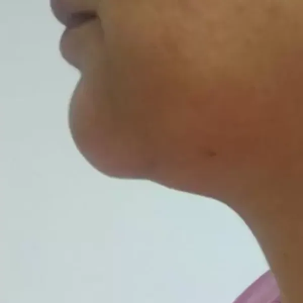 Chin Filler – Before