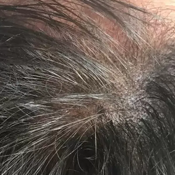 Hair Mesotherapy – After