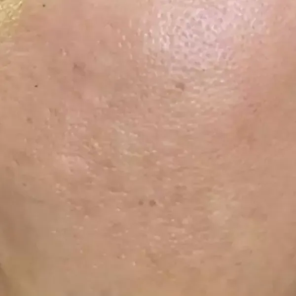 Pigmentation Treatment – After