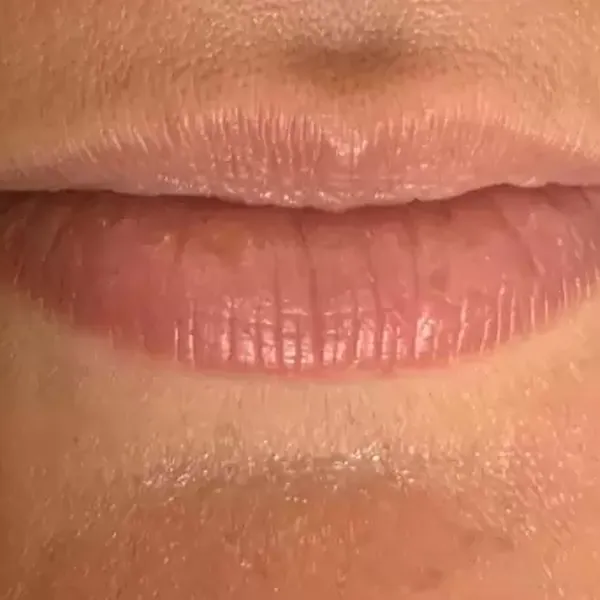 Needle-Free Lip Filler – Before