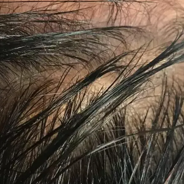 Hair Mesotherapy – Before