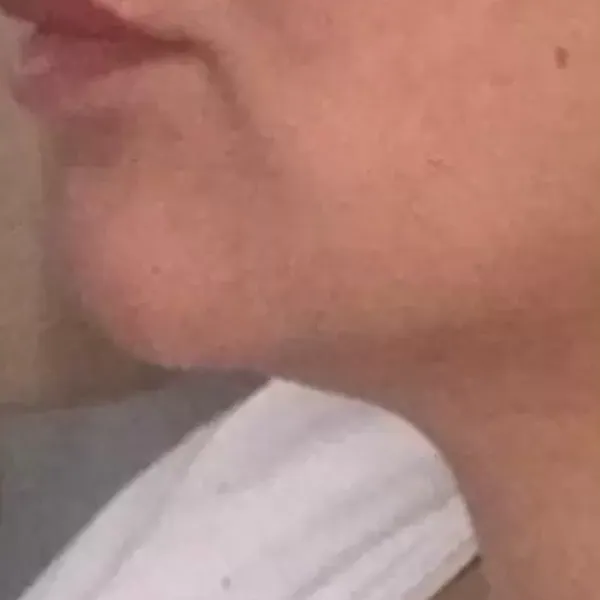 Chin Filler – After