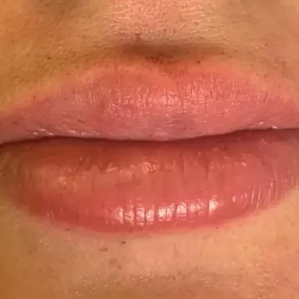 Needle-Free Lip Filler – After