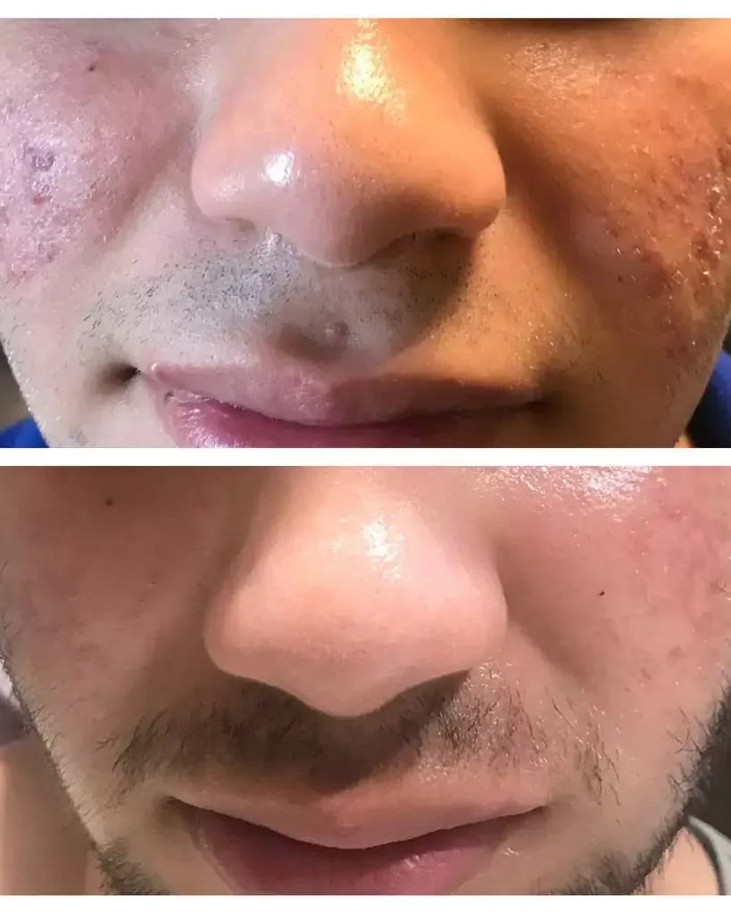 Acne Treatment