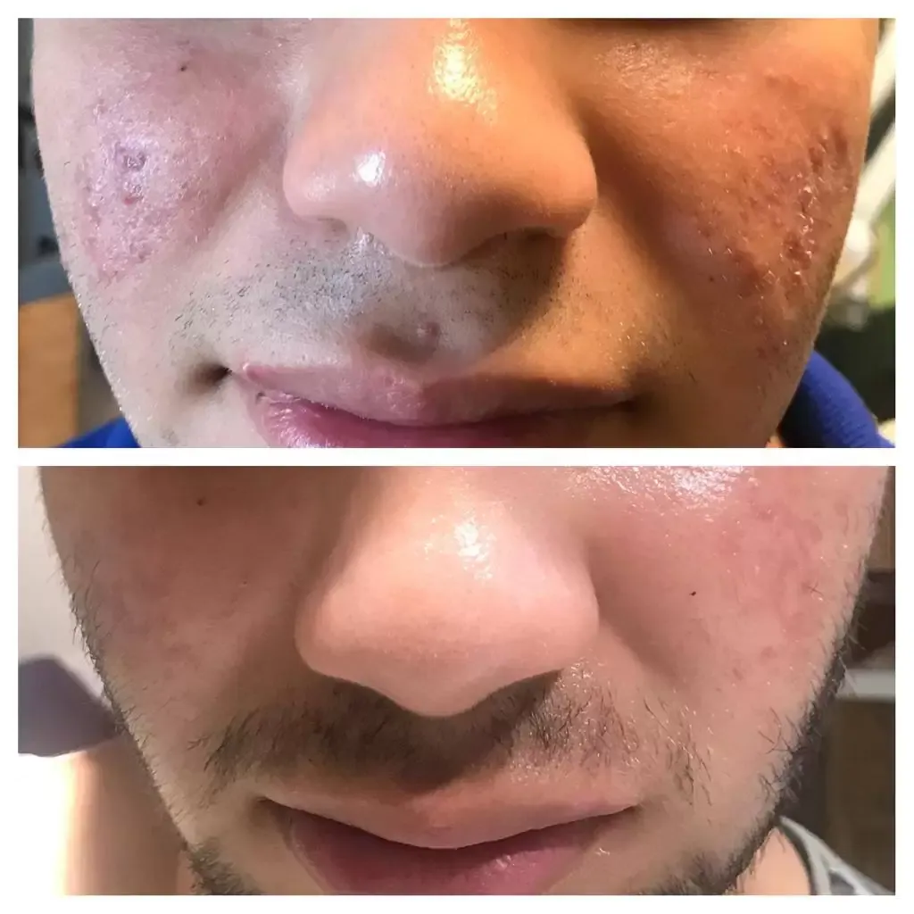 Skin Rejuvenation