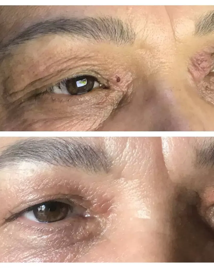 Non-Surgical Eyelid Lift