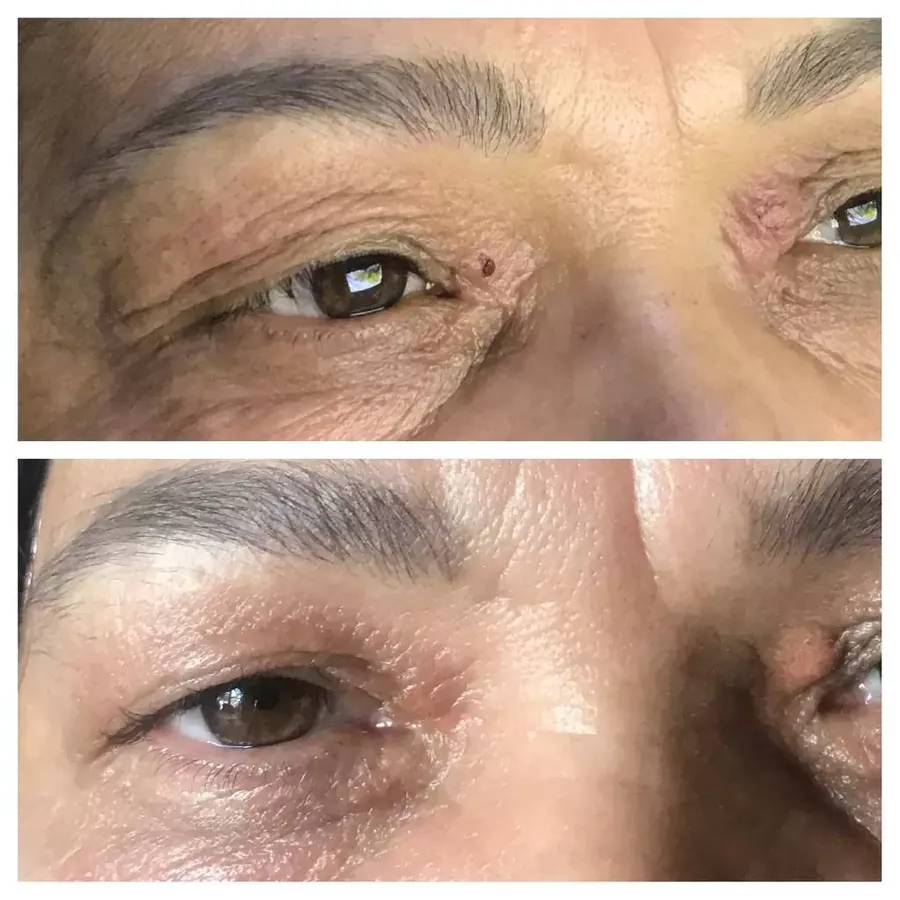 Non-Surgical Eyelid Lift