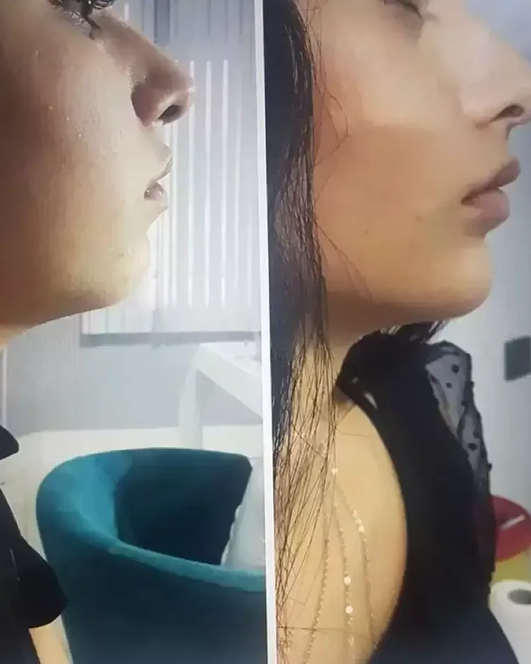 Chin Filler