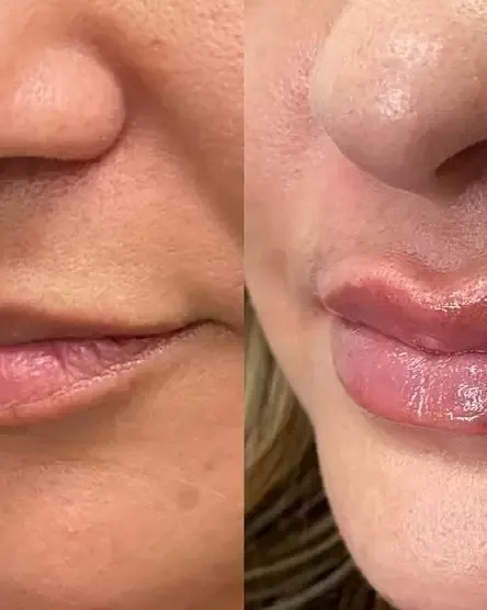 Lip Filler