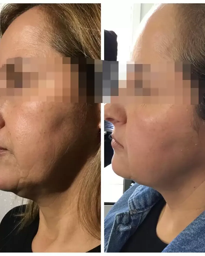 Youth Injections