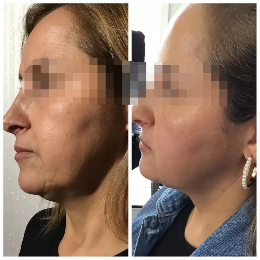 Youth Injections