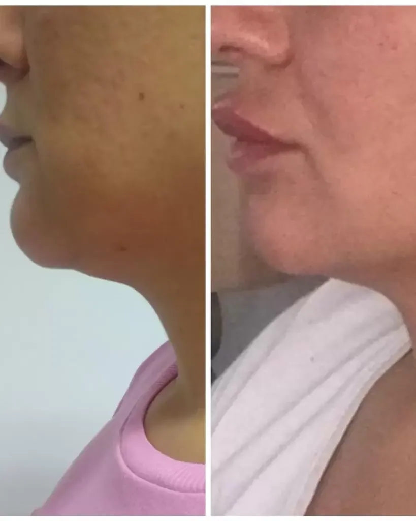 Double Chin Lipolysis