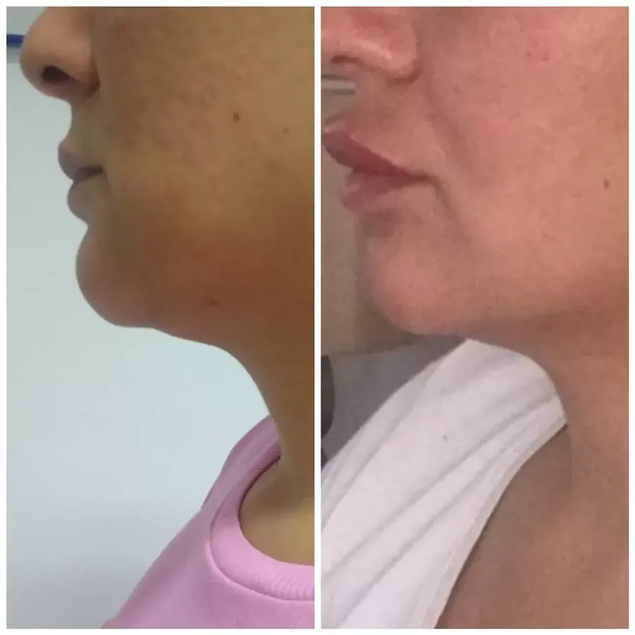 Double Chin Lipolysis