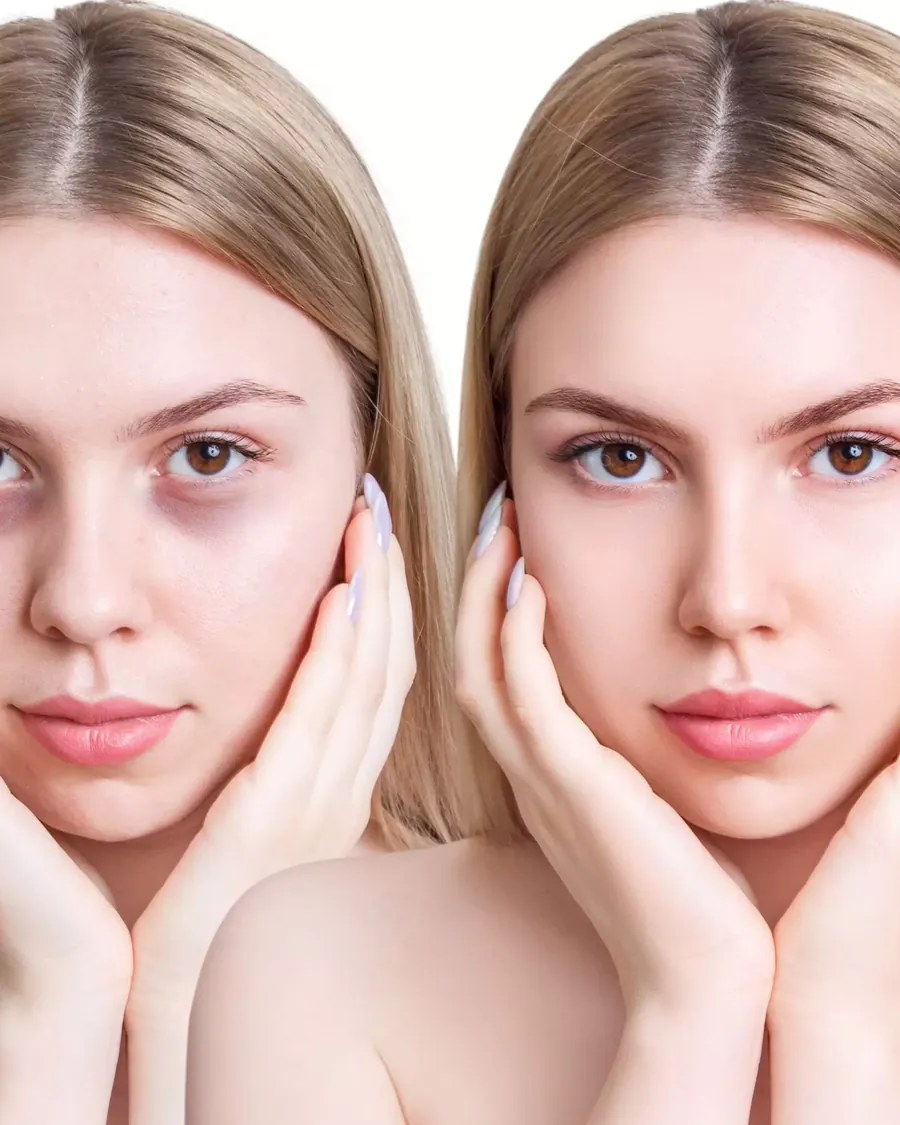 Dark Circles & Puffiness