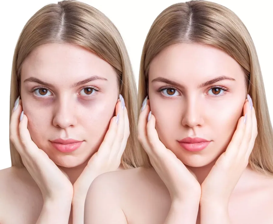Dark Circles & Puffiness