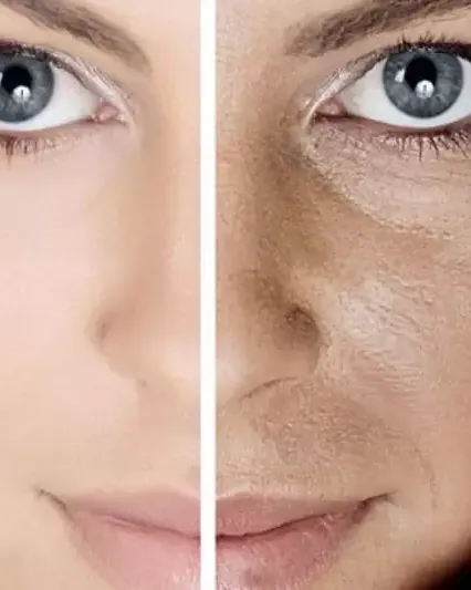 Enlarged Pore Treatment