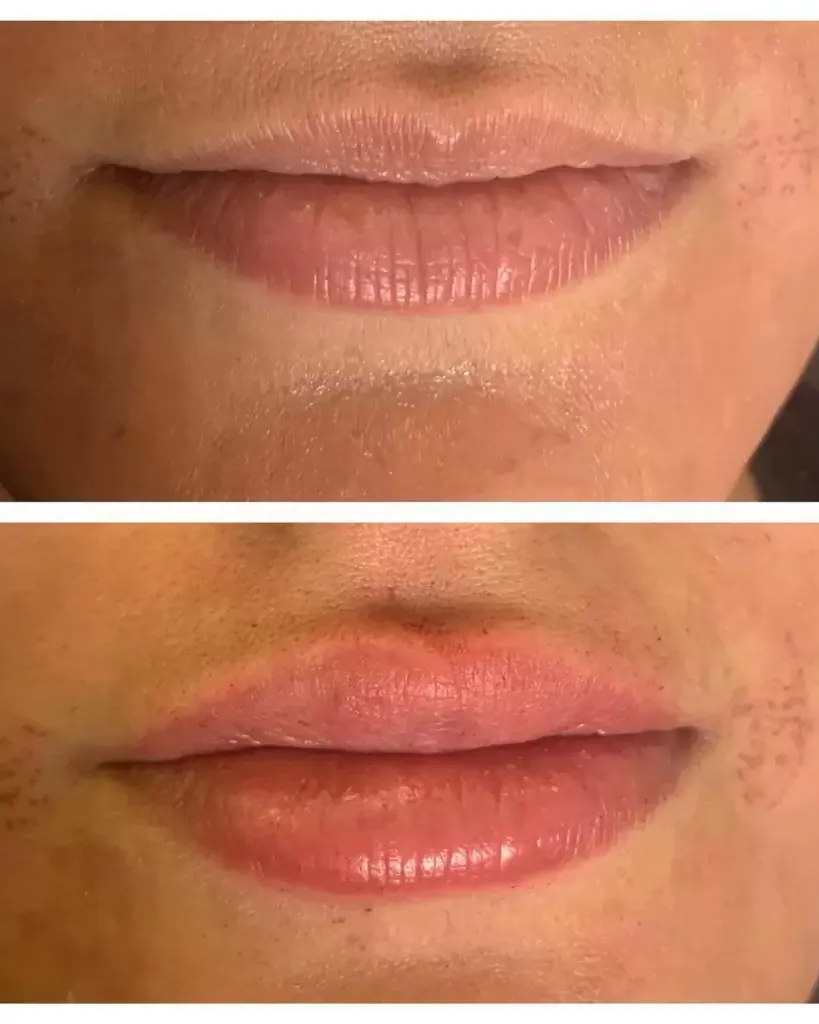 Needle-Free Lip Filler