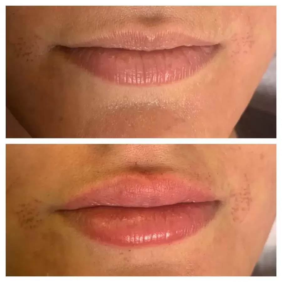 Needle-Free Lip Filler