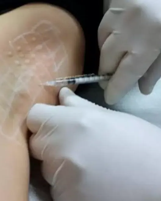 Underarm Botox
