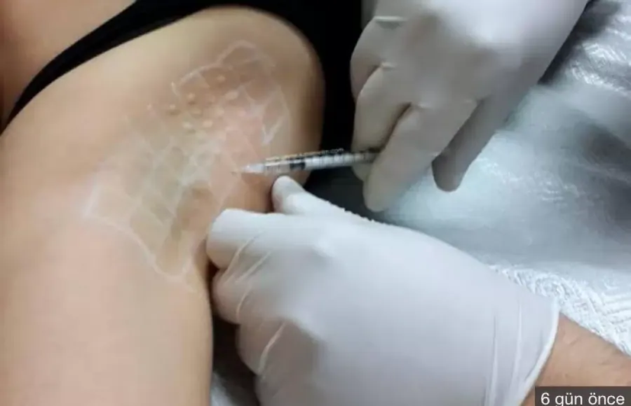 Underarm Botox