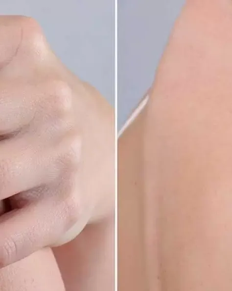 Laser Tattoo Removal