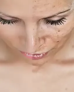Pigmentation Treatment
