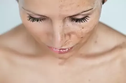 Pigmentation Treatment