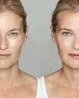 Fruit Acid Peel