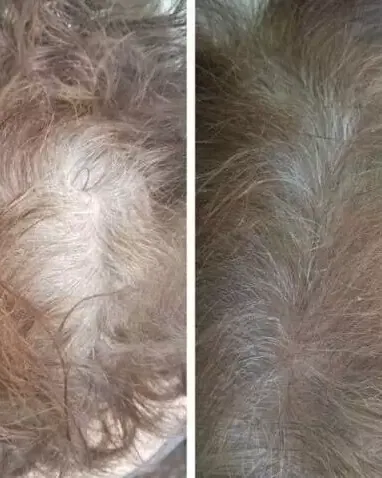 Scalp Micropigmentation