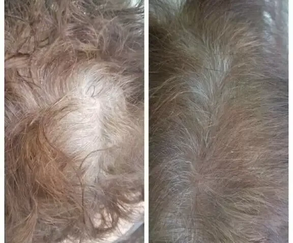 Scalp Micropigmentation